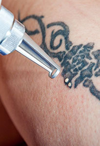 rimozione-tatuaggi