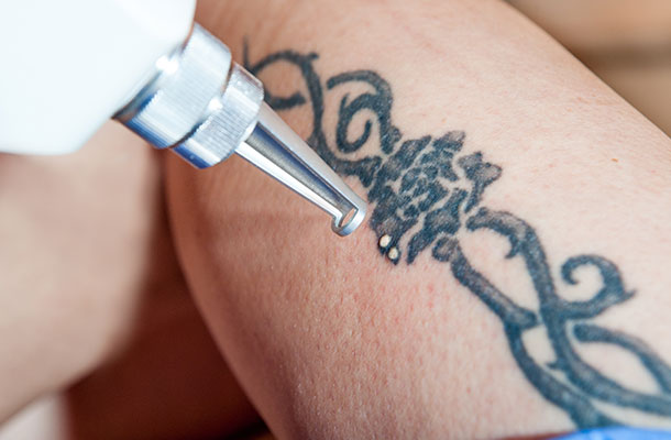rimozione tatuaggi lecce